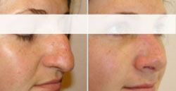 rhinoplastie pas cher 77,meilleur chirurgien77