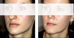 chirugie esthetique menton 92380 génioplastie pas cher 92380,meilleur chirurgien92380