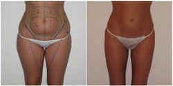 liposuccion pas cher 92330,meilleur chirurgien 92330