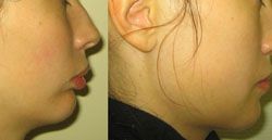 génioplastie prix 93,génioplastie 93