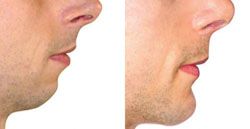 chirurgien esthetique menton 94430