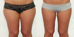 chirurgien esthetique cuisse,ventre paris 3,anches paris 3,liposuccion complete paris 3,culotte de cheval Paris