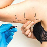 chirurgie esthetique pour une lifting bras en tunisie